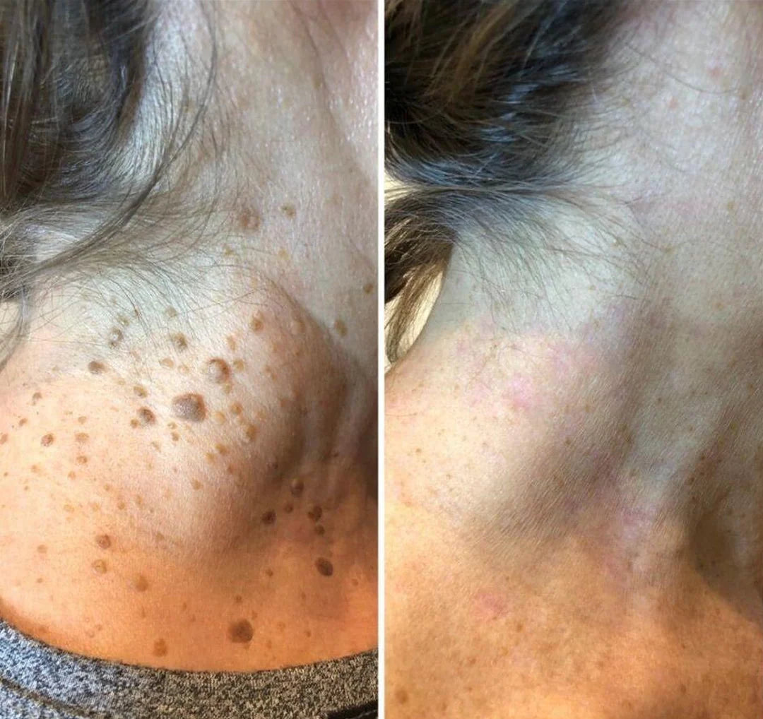 Customer neck result image shown on the CryoClear Pro product page