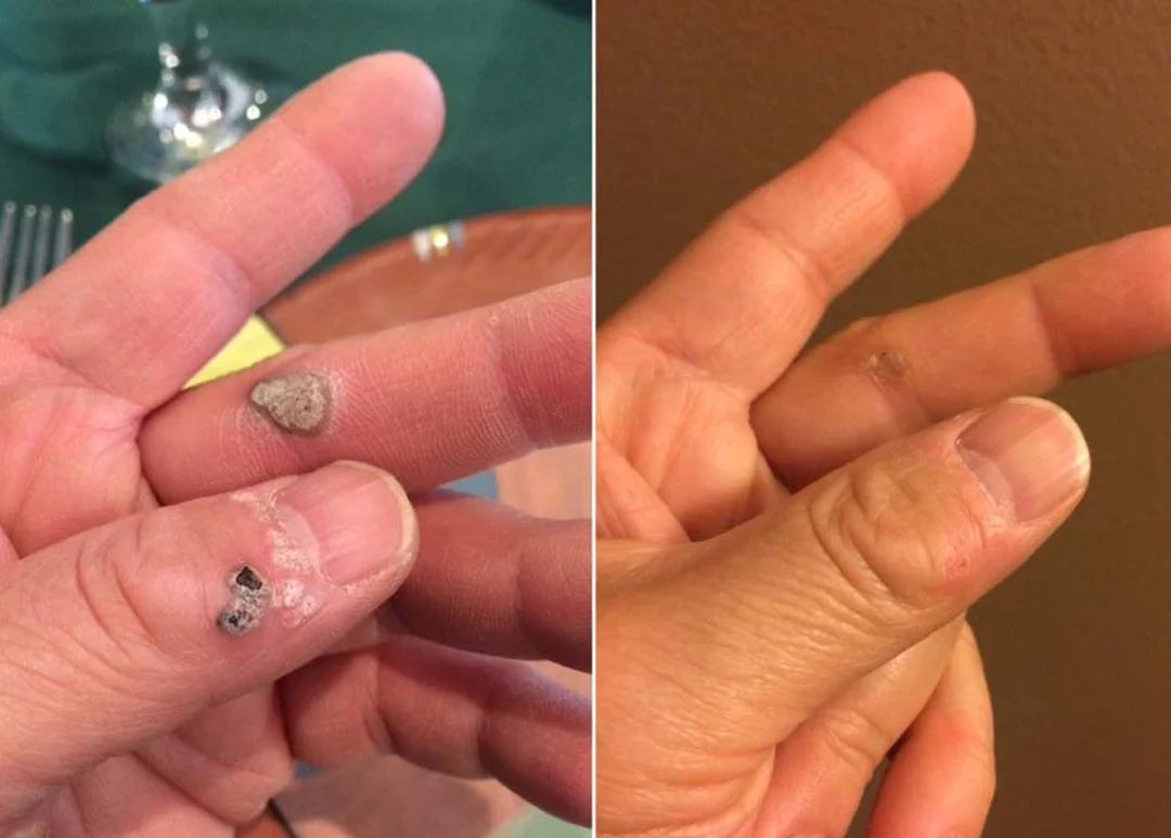 Customer hand result image shown on the CryoClear Pro product page