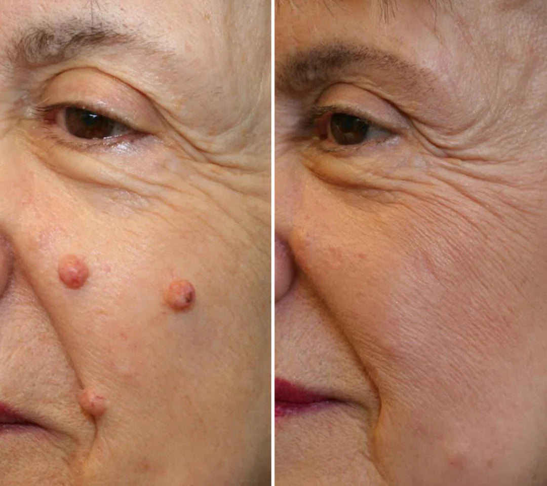 Customer result image shown on the CryoClear Pro product page